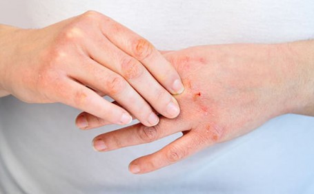 乳膠手套能否有效防止長水泡？